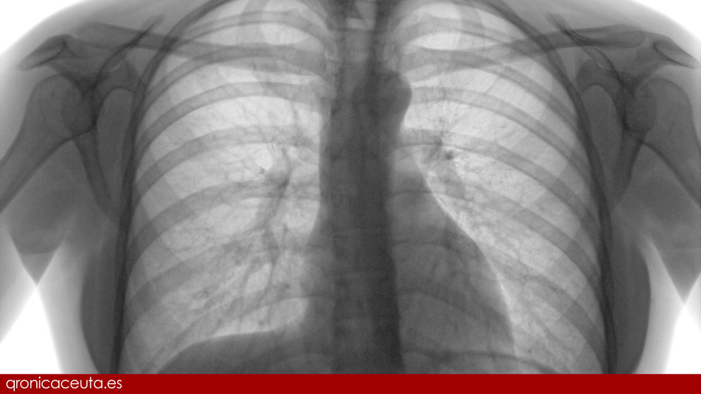 Radiografía pulmones